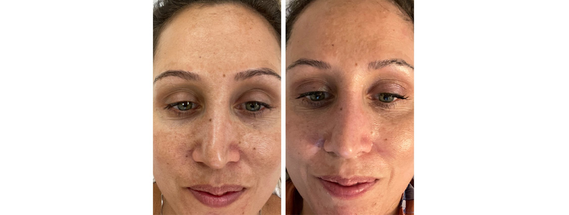 microneedling facial treatment before and after photo