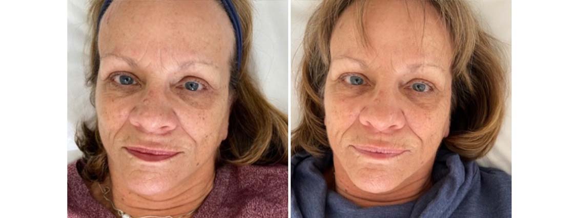 microneedling facial treatment before and after photo